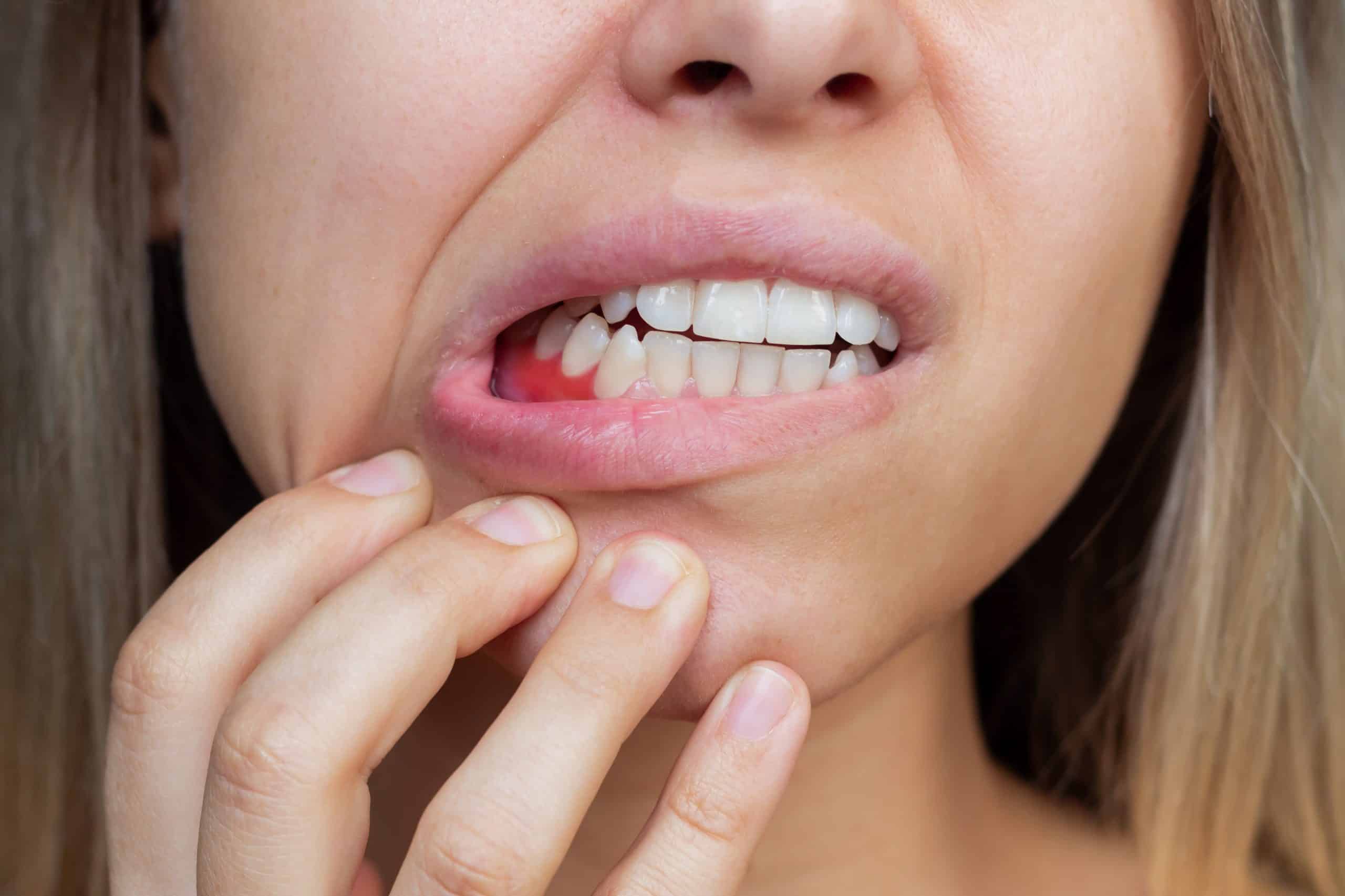 Periodontitis: Guía Completa de Síntomas a Prevención