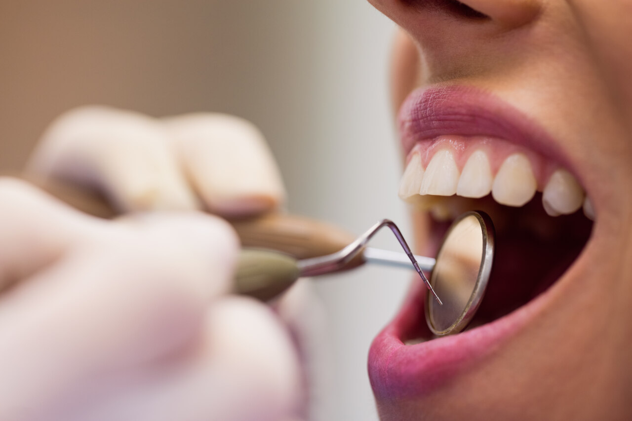 Cómo la Dieta Ayuda a Combatir el Tártaro Dental